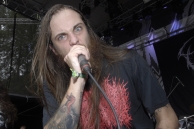 VULVODYNIA